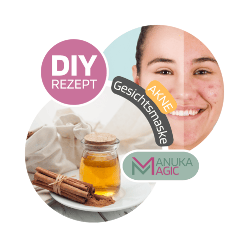 Einfaches DIY Rezept gegen Akne mit Manuka Honig